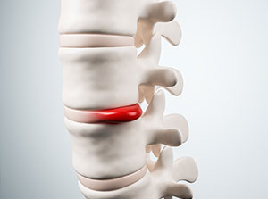 Patient suffering with herniated disc